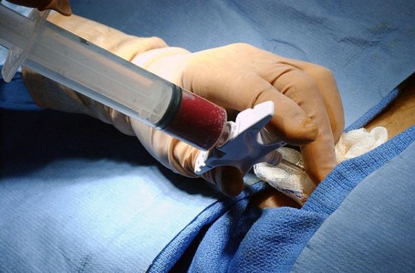 Bone Marrow biopsy