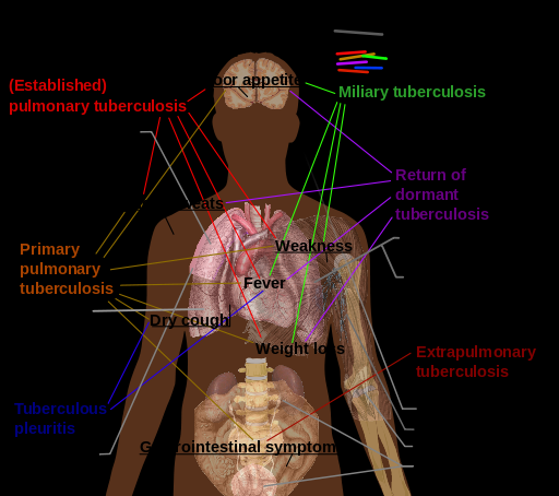 Tuberculosis