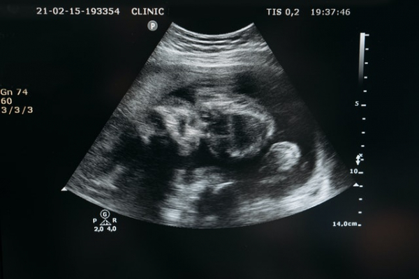 ultrasound showing a baby inside a mother's womb